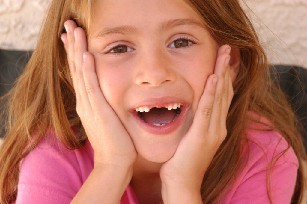Ein Mädchen hält ihren Kopf in ihren beiden Handflächen bei geöffnetem Mund und zeigt ihre Zähne und dabei auch ihre OberkieferZahnlücke infolge des Zahnwechsels der beiden oberen mittleren Schneidezähne.