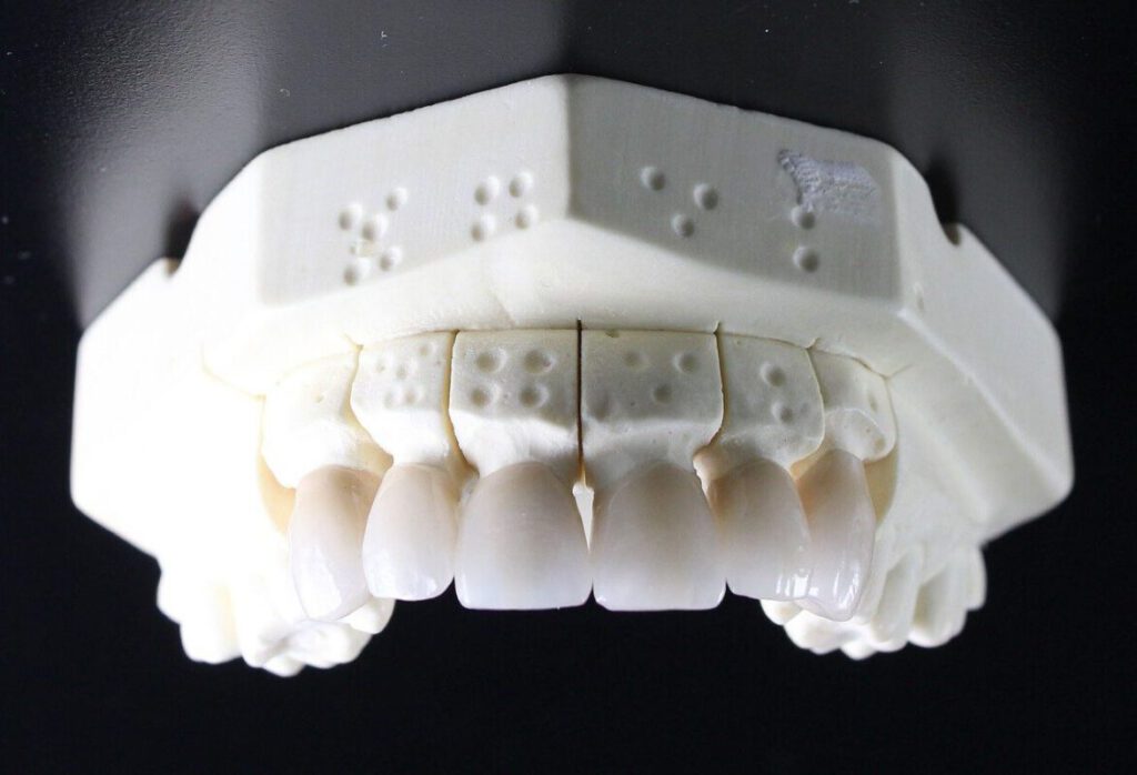 Vier neue weiße Frontzahn-Kronen auf einem Dentalmodell, weiß und strahlend schön, hochwertiger Zahnersatz, Zahnarzt, Zahnarztpraxis