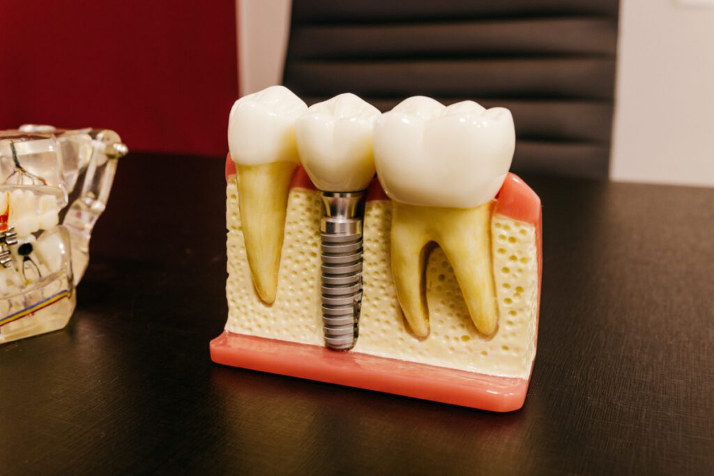 Ein Zahnmodell zeigt im Schnittbild ein Implantat mit Krone in der vorherigen Zahnlücke, Implantate